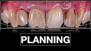 ציפוי חרסינה לשיניים תכנון