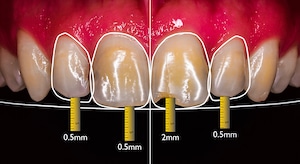 ציפוי למינייט לשיניים תוכנית