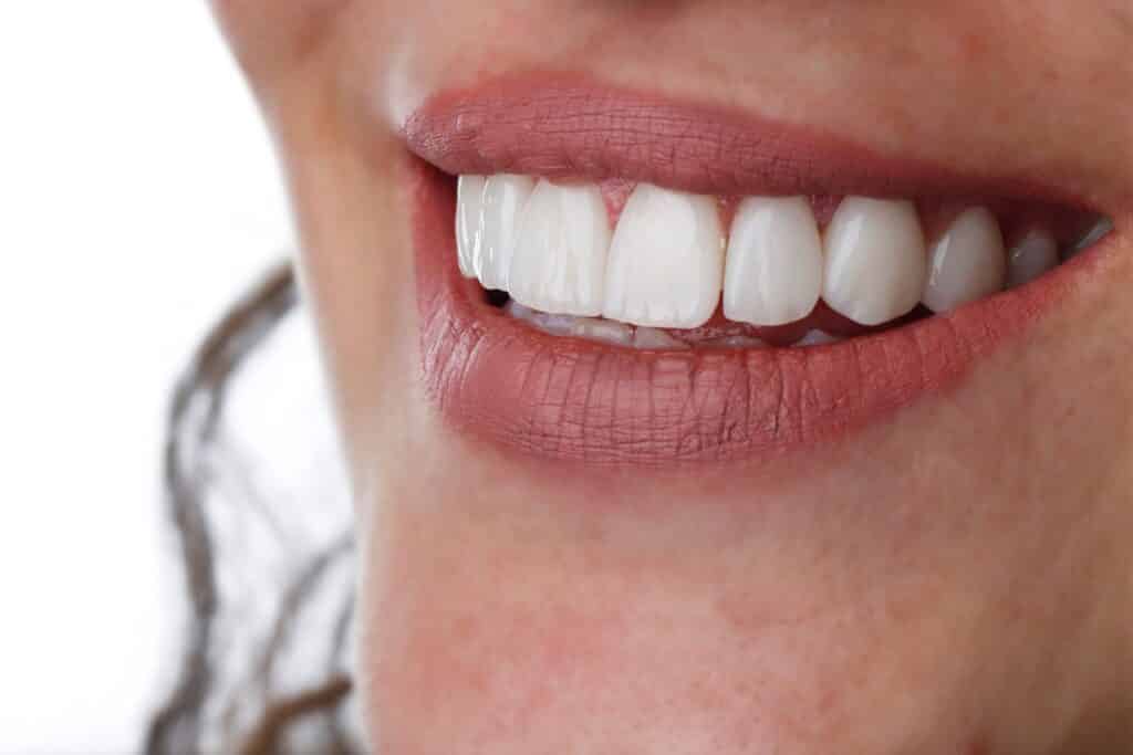 ציפוי חרסינה לשיניים יתרונות וחסרונות