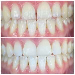 ציפוי שיניים רווחים בין השיניים