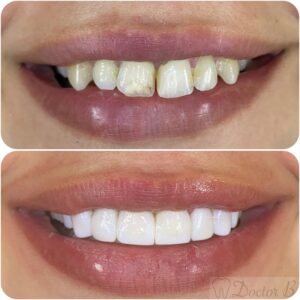 ציפוי שיניים קומפוזיט לשיניים עקומות